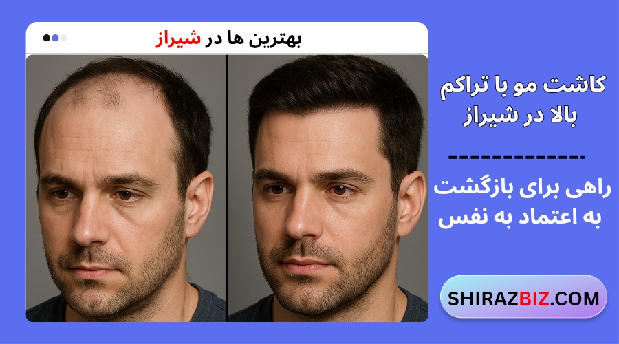 کاشت مو با تراکم بالا در شیراز